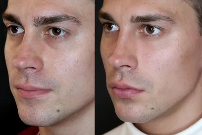 Как ботокс меняет внешность: 35 фото до и после | WDAY