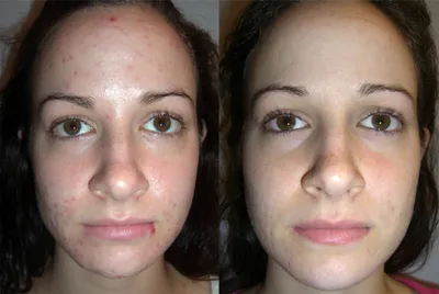 Вся правда о восстановлении лица после чистки у косметолога! | Красота и  уход | Дзен