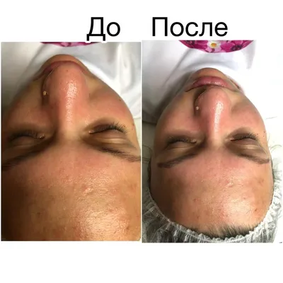 Фото до и после лазерной косметологии | Клиника Damas Clinic на Таганской