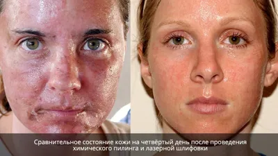 Комбинированная чистка лица - «Чистое личико,не не сразу ✨ Много фото  восстановления кожи☺️Ощущения от чистки лица✨» | отзывы