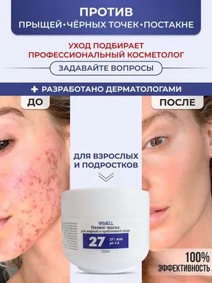 Лазерный пилинг лица: цена от 9990 рублей за процедуру в Москве | Лазерный  пилинг СО2 в клинике BeautyWay Clinic