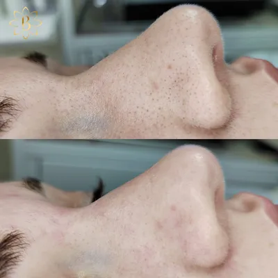 Лазерный пилинг для лица - цена процедуры в Москве, фото до и после |  Доктор Мезо