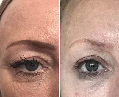 Плазмолифтинг лица: фото до и после, отзывы врачей косметологов, как  проходит процедура