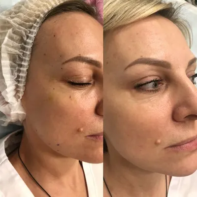 Плазмолифтинг лица: фото до и после, отзывы врачей косметологов, как  проходит процедура