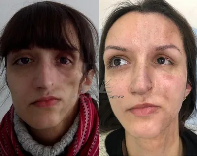 RF-лифтинг лица в Москве: цены, фото до и после, отзывы | Стоимость  RF-лифтинга лица в клинике Seline