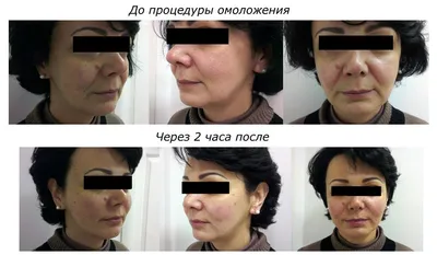 Плазмотерапия для лица в Москве - клиника ЦИДК