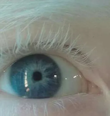 Какого цвета глаза у людей альбиносов? фотографии глаз альбиноса.