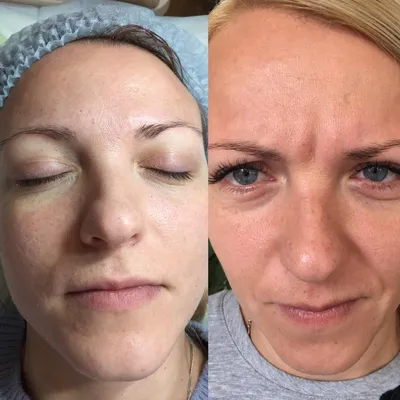 Ботокс от морщин: фото до и после, отзывы | Beauty Insider