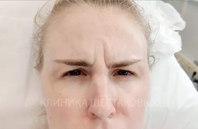 Инъекции ботулотоксина в лоб - клиника лазерной косметологии в Москве