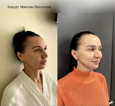 Подтяжка лица хирургическим путем цена в Москве в клиника The Platinental.  Сколько стоит операция по подтяжке лица