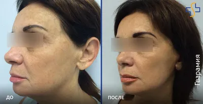 Технология IR - инфракрасного термолифтинга кожи лица и тела