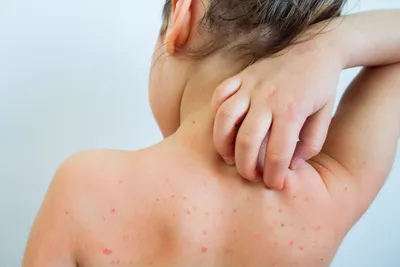Проблемы кожи у детей – почему возникают сыпи, мокнутия, шершавость и  прочие проблемы | О детском здоровье: с врачебного на родительский | Дзен