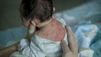 Проявления коронавируса: какие высыпания на коже должны насторожить | РБК  Стиль