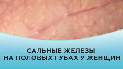 Гранулы фордайса на губах, фото до и после, удаление в клинике Medicris