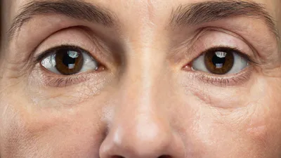 Малярные мешки под глазами: что с ними делать | BURO.