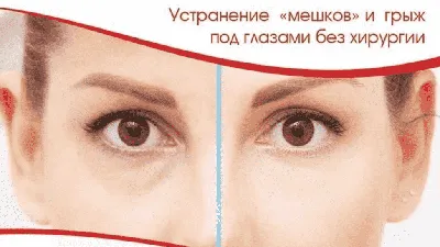 Удаление малярных мешков под глазами, цена пластической операции в VIP  Clinic в Москве