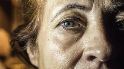 Малярные мешки под глазами: как косметолог поможет их убрать | Сеть клиник  ЛИНЛАЙН