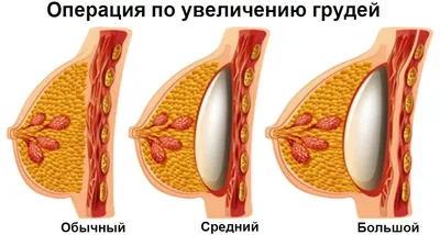 Маммопластика груди цена на операцию в Москве