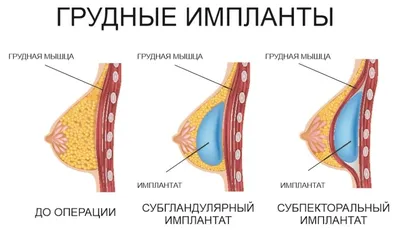 Асимметрия груди после маммопластики | igor-butko.ru