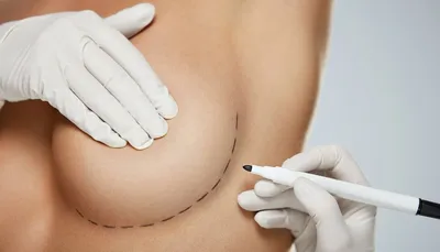 Маммопластика - ваша новая грудь! | Статьи