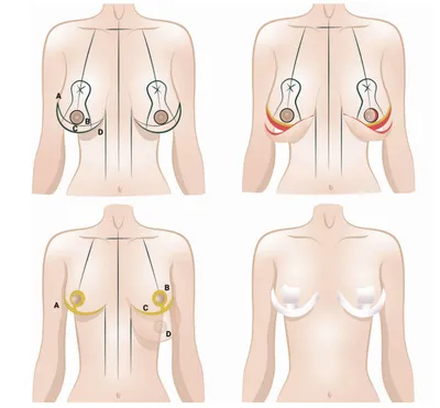Пластика груди - до и после. Увеличивающая маммопластика. | Хирургия,  Грудь, Пластическая хирургия