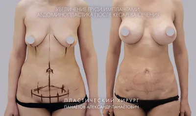 Маммопластика — увеличение груди в Новосибирске, цены на пластику груди в  клинике доктора Рогажинскас
