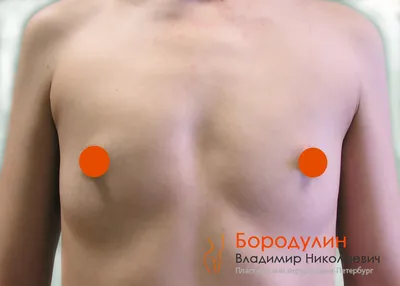 Уменьшение груди операция в Минске, редукционная маммопластика цена