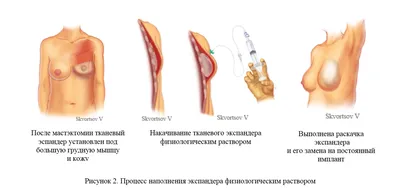 Реконструкция молочной железы (мастэктомия) в Москве: цена операции,  показания к проведению