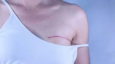 Линии - Реконструкция груди, выполненная в два этапа и профилактическая  подкожная мастэктомия справа. | Facebook