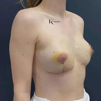 Подтяжка груди в Москве - ❤️ Цена на мастопексию