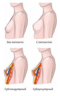Подтяжка груди в Киеве | Цена 2022 операции мастопексии | Отзывы