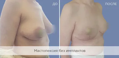 Подтяжка груди с имплантами | Пластический хирург Осин Максим Александрович