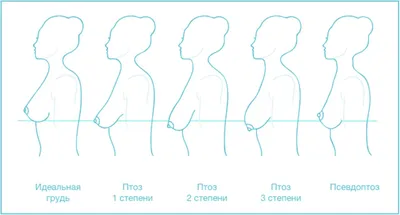 Мастопексия (подтяжка груди без имплантов) в Москве: цены, сделать операцию  у профессионалов | Клиника Доктора Росса