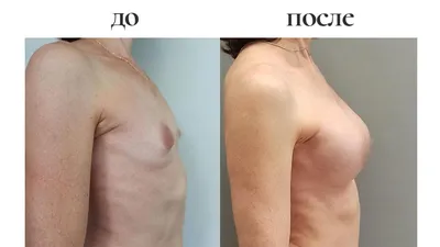 Маммопластика груди. Цены в Москве на коррекцию, маммопластику, операцию  пластика грудных желез. Стоимость маммопластики в Москве уточняйте по  телефону