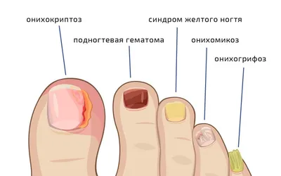 Диагностика заболеваний внутренних органов по состоянию ногтей :: Теория