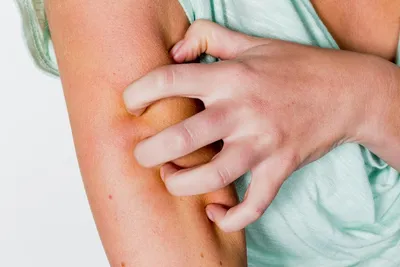 Берегите руки: как быстро помочь сухой и раздраженной коже