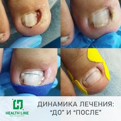 Педикюр медицинский 👣- медицинский педикюр Киев, цена на подологический  педикюр в косметологической клинике Медлас