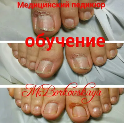 Медицинский педикюр - ⚒ #tiraspodoработы ⚒. . . На фото ногти после  чистки👣. . . ✓Вам нужен подолог👤, если наблюдаются: ⬇️ ⬇️ ❗️грибковые  заболевания стоп ног; ❗️неприятный запах, ❗️повышенная потливость или  сухость