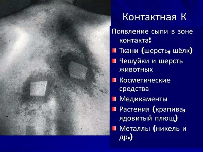 Реакция кожи на шугаринг. Кожные реакции после депиляции | Обучение  шугарингу и депиляции | Shugar.PRO | Дзен