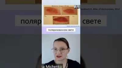 Инвазивная меланома кожи | MyPathologyReport.ca