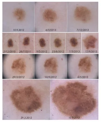 Меланома кожи - о болезни, алгоритм обследования, тесты и анализы