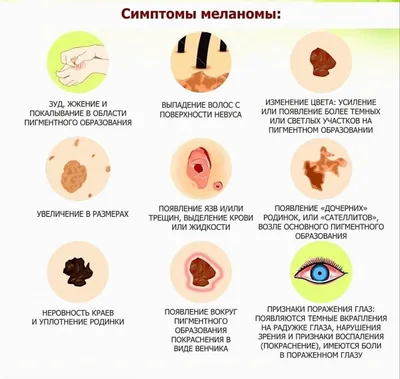 Внутриглазная меланома | Premilife - Homeopathic Remedies