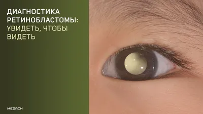 Меланома глаза» — Яндекс Кью