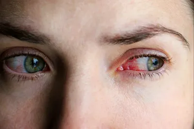Меланома глаза - MDI Clinic