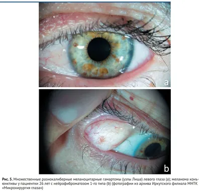 рис. 5. Множественные разнокалиберные меланоцитарные гамартомы (узлы Л…