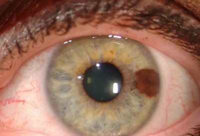 Меланома глаза