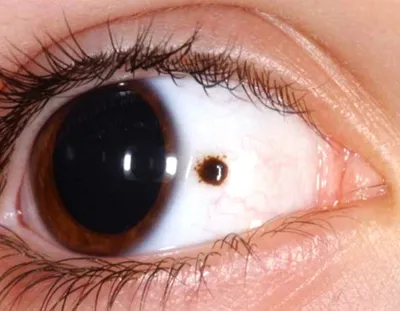 Что такое меланома глаза?» — Яндекс Кью