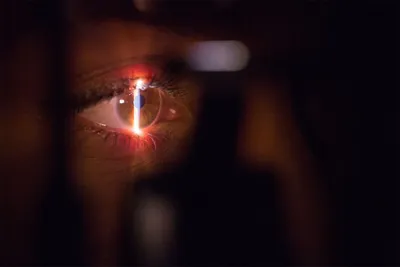 Наталия Турыгина | Офтальмолог | Москва | Лазерная коррекция on Instagram: \" Меланома сосудистой оболочки глаза (хориоидеи) - это самая распространённая  злокачественная опухоль в глазу ❗️ Выявляется примерно у 5-10 человек на  миллион