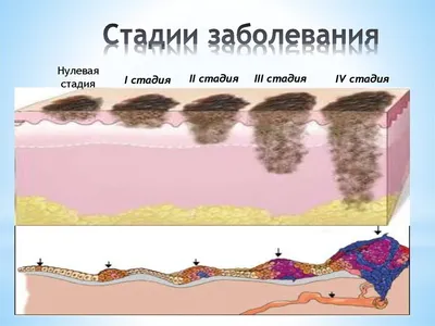 Акральная лентигинозная меланома uMEDp