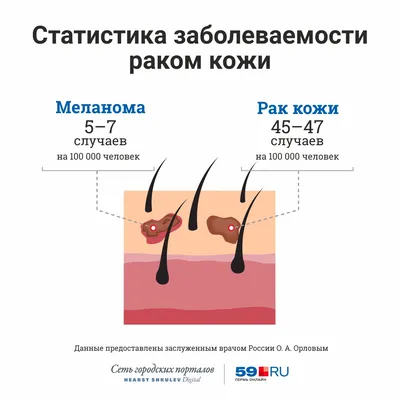21 мая в Ростовском онкоцентре пройдет акция по раннему выявлению меланомы  кожи